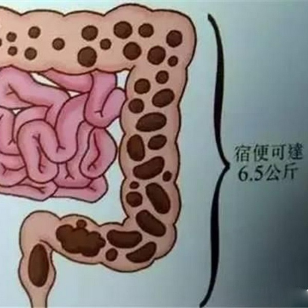 便秘怎么办